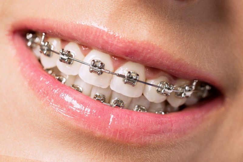Зубные брекеты